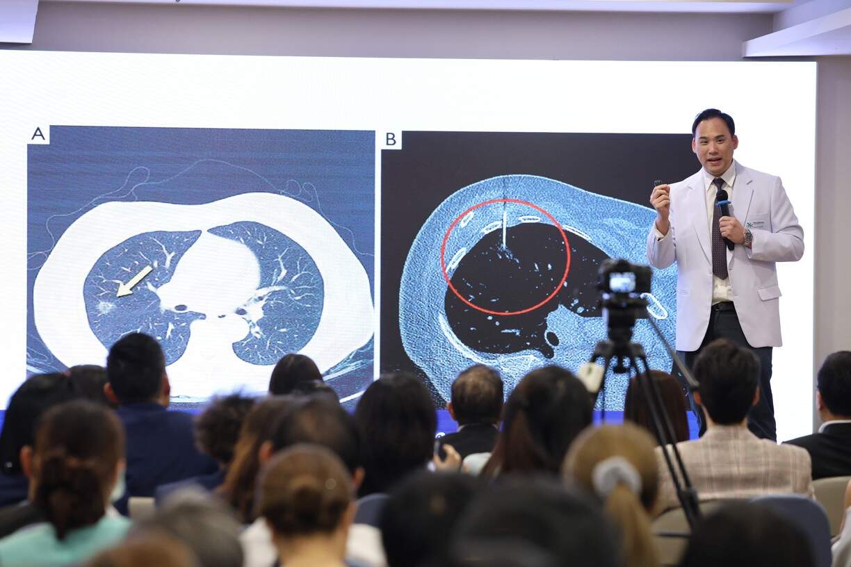 แพทย์ชี้ผู้ป่วยมะเร็งปอดกว่า 70% รู้ตัวเมื่อลุกลาม ชูเทคโนโลยี 'Inspectra CXR' ดันโอกาสรอดพุ่ง 90%